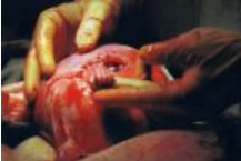 Aborto por operación cesárea